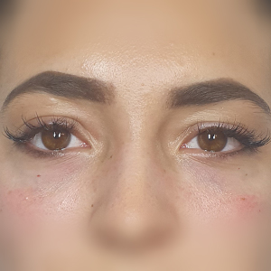 Teosyal hyaluron kezelés -1ml